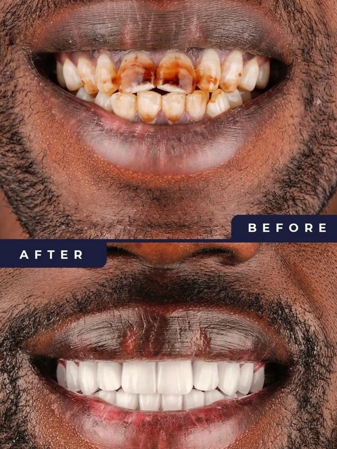 Patient smile result