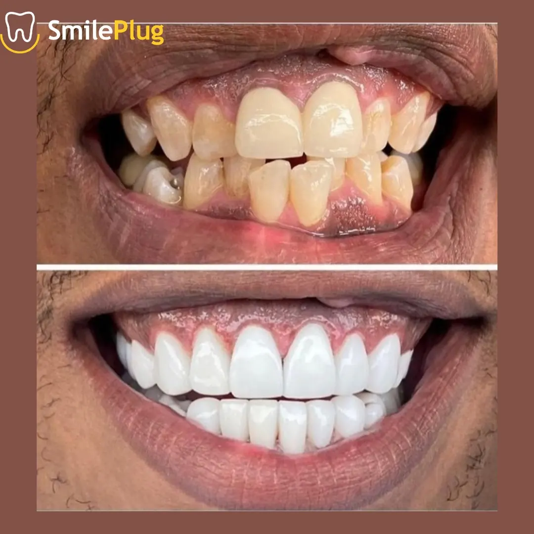 Patient smile result