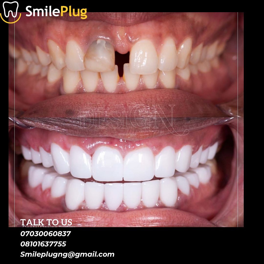 Patient smile result