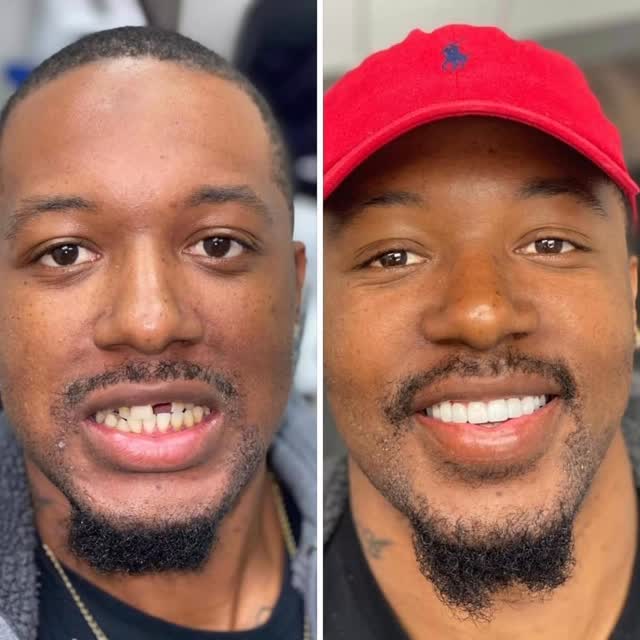 Before-and-after smiling portraits of a patient